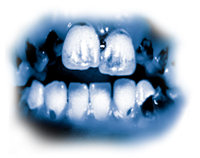 Les ingrédients toxiques de la meth provoquent de graves caries dentaires connues sous le nom de « bouche meth ». Les dents deviennent noires, tachées et cariées, au point où il faut souvent les arracher. Les dents et les gencives sont détruites de l’intérieur et les racines se gâtent.